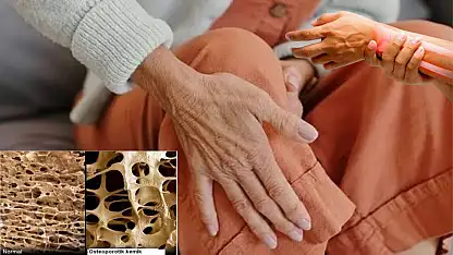 Kemik erimesi sessiz ilerliyor! Erken tanı kırık riskini azaltıyor