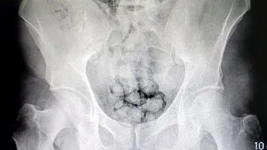 Uyuşturucuları midelerinde saklayan şahıslar adliyede...