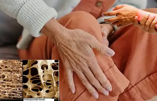 Kemik erimesi sessiz ilerliyor! Erken tanı kırık riskini azaltıyor
