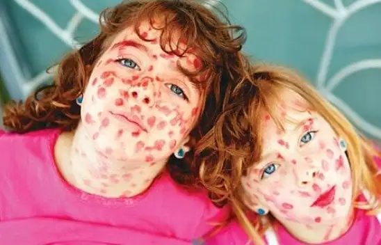 Kızamık nedir? Belirtileri nelerdir?