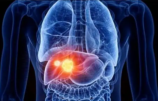 Wilson Hastalığına Dikkat!