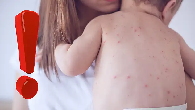 Bakanlık kızamık hastalığına dikkat çekti!