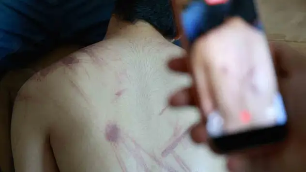 14 yaşında ki Down sendromlu çocuğa, rehabilitasyon merkezinde şiddet uygulandığı iddia edildi!