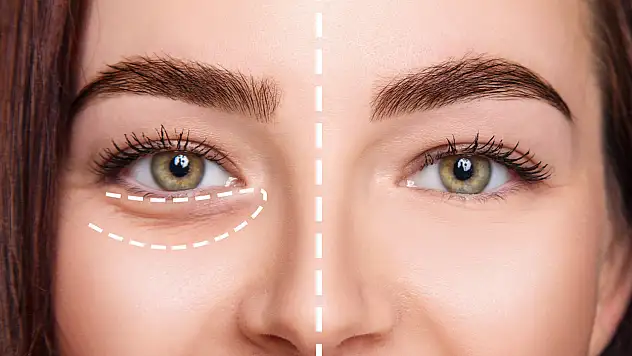 Göz Altında Oluşan Morluklara Dikkat - Göz Altı Işık Dolgusu Nedir?