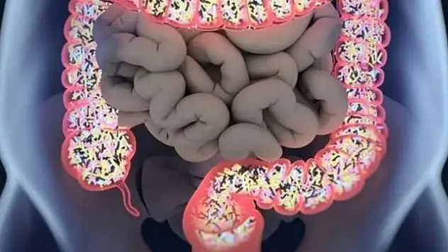 İnflamatuar Bağırsak Hastalığı'na Çözüm Bulundu