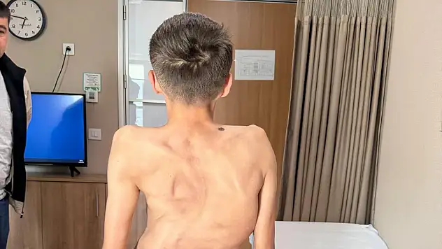 Skolyozla yıllarca mücadele etti, çareyi Türkiye'de buldu