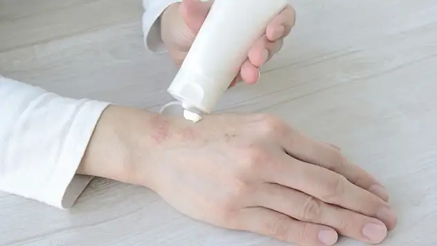 Kışın 'soğuk ısırmasına' dikkat!