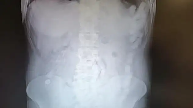 Kayseri'de midesinde 100 kapsül ile yakalandı!