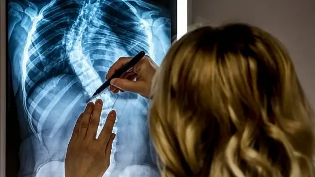 Skolyozda tehlike sessiz ilerliyor: Belirtileri ciddiye alın