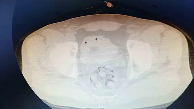 Nevşehir'de şüpheli ölüm: Otopside vücudundan 8 kapsül daha çıktı