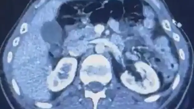 İran'dan Kayseri'ye midelerinde uyuşturucu ile gelen şüpheliler yakalandı!