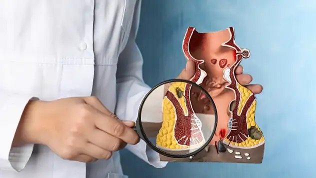 Uzun süre oturanlar risk altında: Sağlık Bakanlığı'ndan hemoroid açıklaması