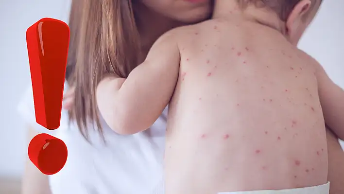 Bakanlık kızamık hastalığına dikkat çekti!