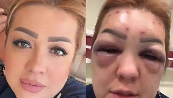 Botoks sonrası yüzü şişen kadın hastanelik oldu