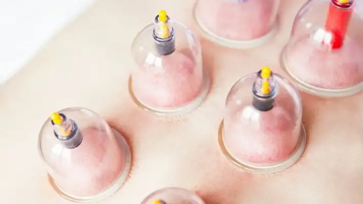 Eylül ayı hacamat günleri ne zaman? Altın gün yaklaşıyor!