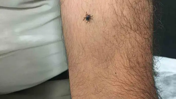 Kayseri'nin bir ilçesinde daha bir yeni kene vakası!