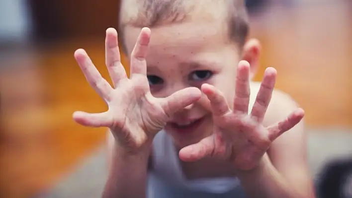 Uzman uyardı: El, ayak ve ağız hastalığı kreşlerde hızla yayılıyor